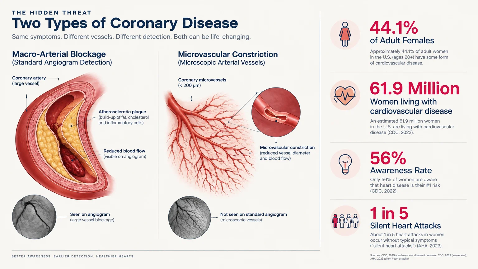 Infographic comparing macro-arterial blockage with microvascular constriction alongside statistics on female heart disease.